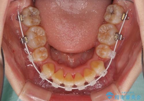 飛び出した前歯を引っ込めたい 目立たないワイヤーでの抜歯矯正の治療中