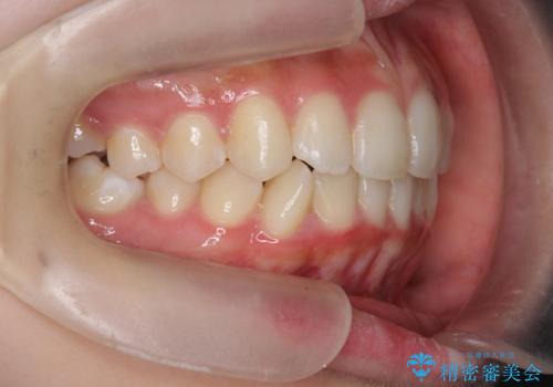 インビザラインライトで行う短期マウスピース矯正治療の治療後