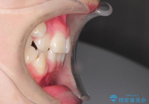 八重歯が気になる ワイヤーによる抜歯矯正できれいな歯並びへの治療前