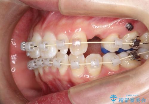 ワイヤー矯正とオールセラミックの組み合わせ治療の治療中