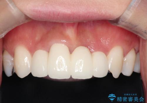 3年間仮歯 前歯セラミックブリッジの治療後