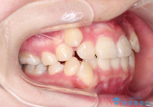 八重歯が気になる ワイヤーによる抜歯矯正できれいな歯並びへの治療前