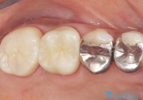 歯磨きすると痛い 不適合なクラウンのやりかえ 70代女性の症例 治療後