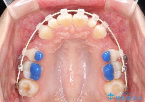 ワイヤー矯正とオールセラミックの組み合わせ治療の治療中