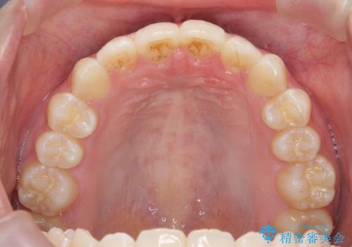 インビザラインライトで行う短期マウスピース矯正治療の症例 治療後
