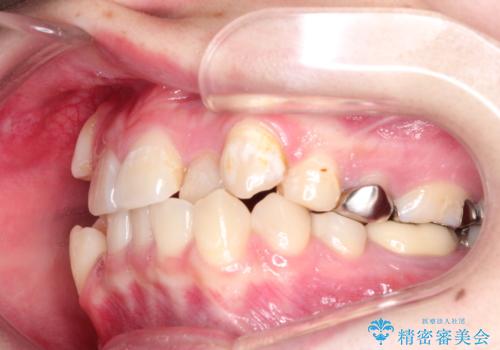 八重歯が気になる ワイヤーによる抜歯矯正できれいな歯並びへの治療前