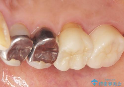 歯磨きすると痛い 不適合なクラウンのやりかえ 70代女性の治療後