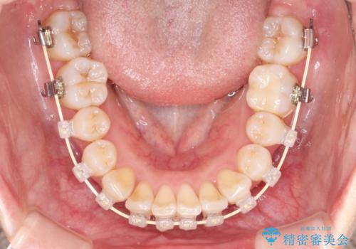 ワイヤー矯正とオールセラミックの組み合わせ治療の治療中