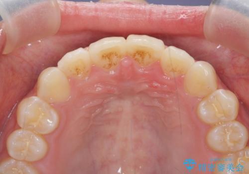インビザラインライトで行う短期マウスピース矯正治療の治療後