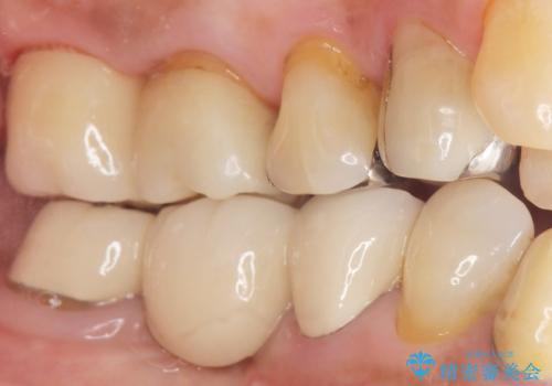 歯磨きすると痛い 不適合なクラウンのやりかえ 70代女性の治療後