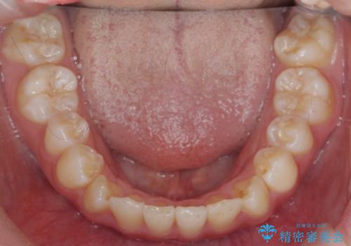 インビザラインライトで行う短期マウスピース矯正治療の治療後