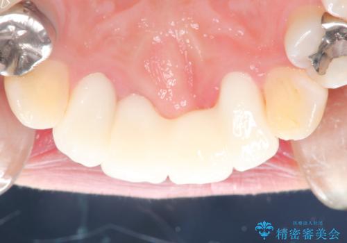 3年間仮歯 前歯セラミックブリッジの治療後