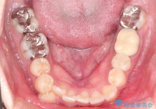 八重歯が気になる ワイヤーによる抜歯矯正できれいな歯並びへの治療前