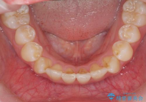 インビザラインライトで行う短期マウスピース矯正治療の治療後
