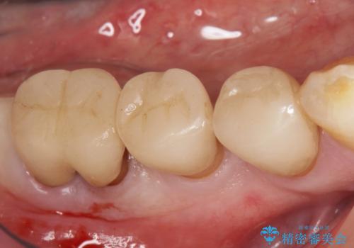 奥歯のインプラント　70代男性の症例 治療前