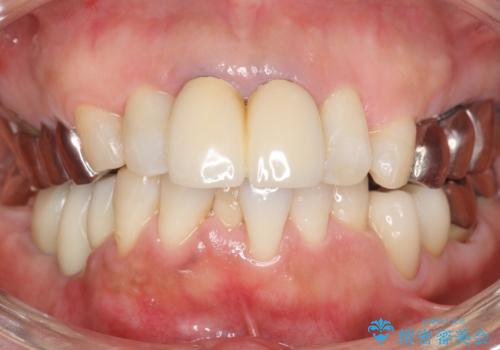 骨が薄く他院でインプラントできないと言われた 50代女性の治療後