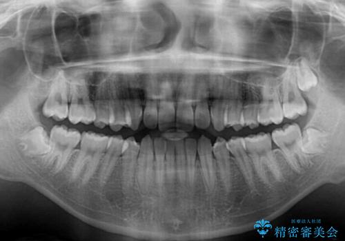 しっかり使って短期間で治療 インビザラインによる叢生解消の治療前