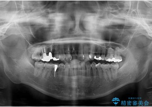 前歯のクロスバイトと治療が必要なむし歯　矯正とセラミックの総合歯科治療の治療前