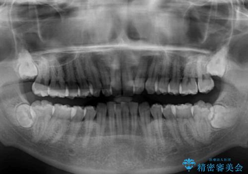 強い咬み込みですり減った前歯 デコボコを抜歯矯正で整えるの治療前