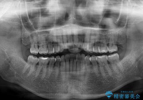 前歯のスペースが気になる インビザラインによる矯正治療の治療前