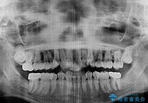上顎の八重歯と下顎前歯の欠損 ワイヤー装置による抜歯矯正の治療前