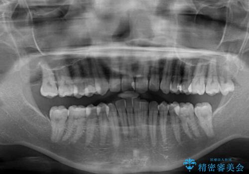 沖縄から飛行機で通院 インビザラインによる矯正治療の治療前