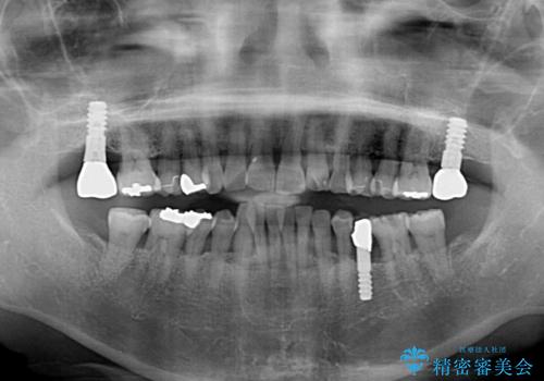 口元の出っ張りとデコボコを改善したいの治療前