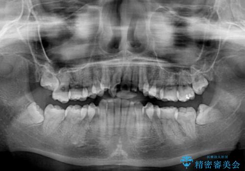 八重歯の抜歯矯正 補助装置を用いたインビザライン矯正の治療前