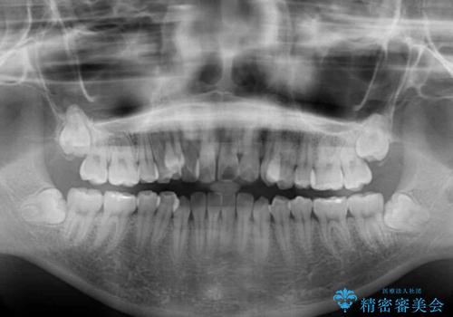 補助装置を使ったインビザラインによる抜歯矯正の治療前