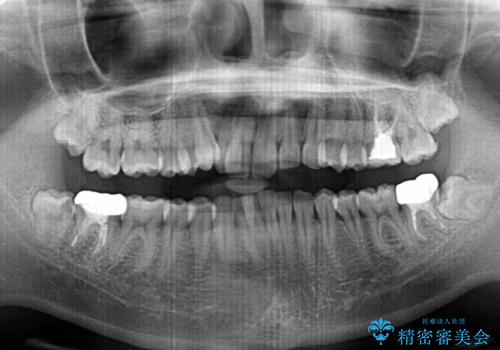 気になる八重歯を改善 補助装置併用のインビザライン治療の治療前