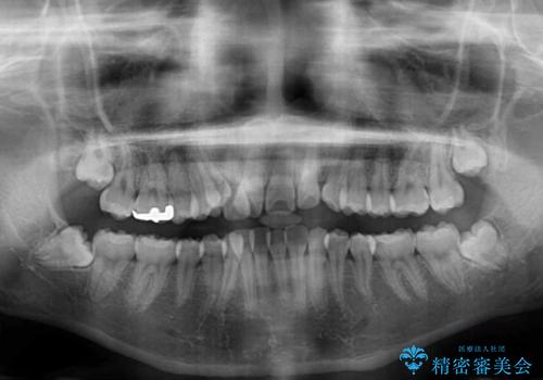 八重歯で正中が右にずれている ワイヤー装置での抜歯矯正で正中位置を改善の治療前