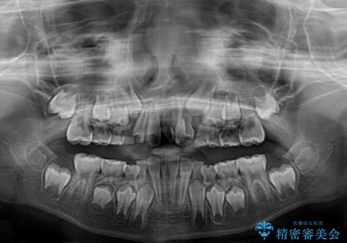 過剰歯を抜歯して前歯を排列　インビザライン・ファーストによる小学生のⅠ期治療の治療前