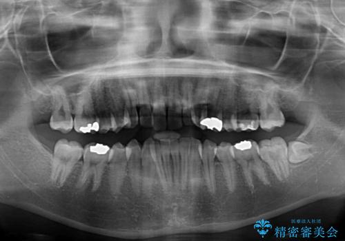 短期間での治療 急速拡大装置を併用したワイヤー装置による矯正治療の治療前