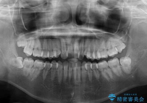 ワイヤー矯正を併用し、リスクを回避しながらのインビザライン矯正治療の治療前