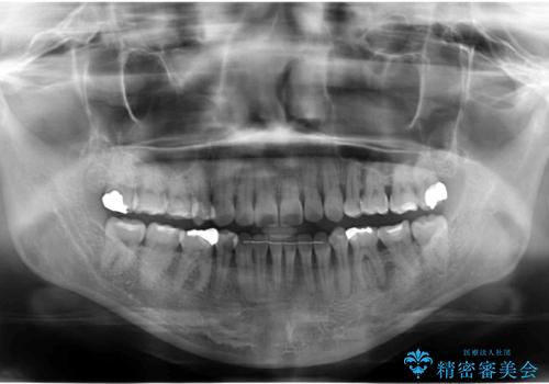 全体的な虫歯治療 の治療前