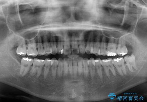 気になる前歯を治したい インビザラインで気づかれずに矯正治療の治療前