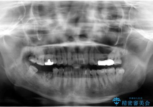 虫歯を放置 しっかり治療したい。 抜歯してインプラント治療の治療前