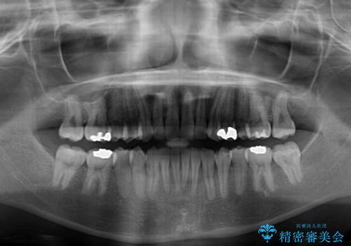 短期間での治療 急速拡大装置を併用したワイヤー装置による矯正治療の治療後