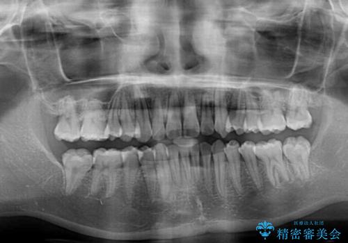 【モニター】犬歯のクロスバイトを目立たないワイヤー装置での治療後
