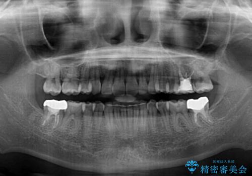 気になる八重歯を改善 補助装置併用のインビザライン治療の治療後