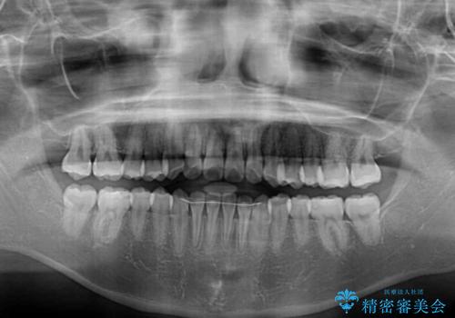 ワイヤー矯正を併用し、リスクを回避しながらのインビザライン矯正治療の治療後
