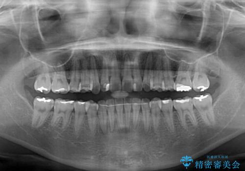 気になる前歯を治したい インビザラインで気づかれずに矯正治療の治療後