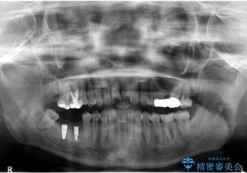 虫歯を放置 しっかり治療したい。 抜歯してインプラント治療の治療中