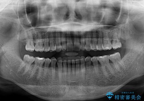 前歯のスペースが気になる インビザラインによる矯正治療の治療後