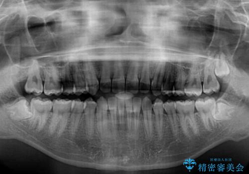しっかり使って短期間で治療 インビザラインによる叢生解消の治療後