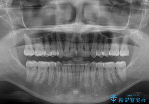 沖縄から飛行機で通院 インビザラインによる矯正治療の治療後