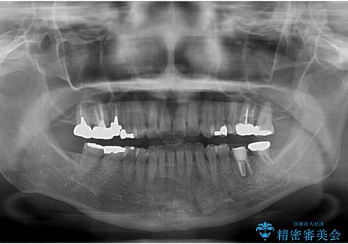 痛む奥歯と矯正の後戻り インビザライン・ライトとセラミック治療の治療前
