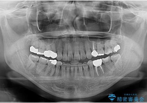 全体的な虫歯治療 の治療後