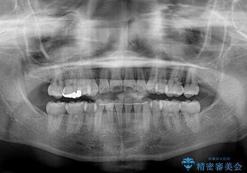 八重歯で正中が右にずれている ワイヤー装置での抜歯矯正で正中位置を改善の治療後
