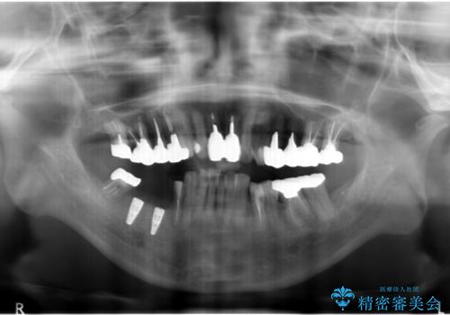骨が薄く他院でインプラントできないと言われた 50代女性の治療中